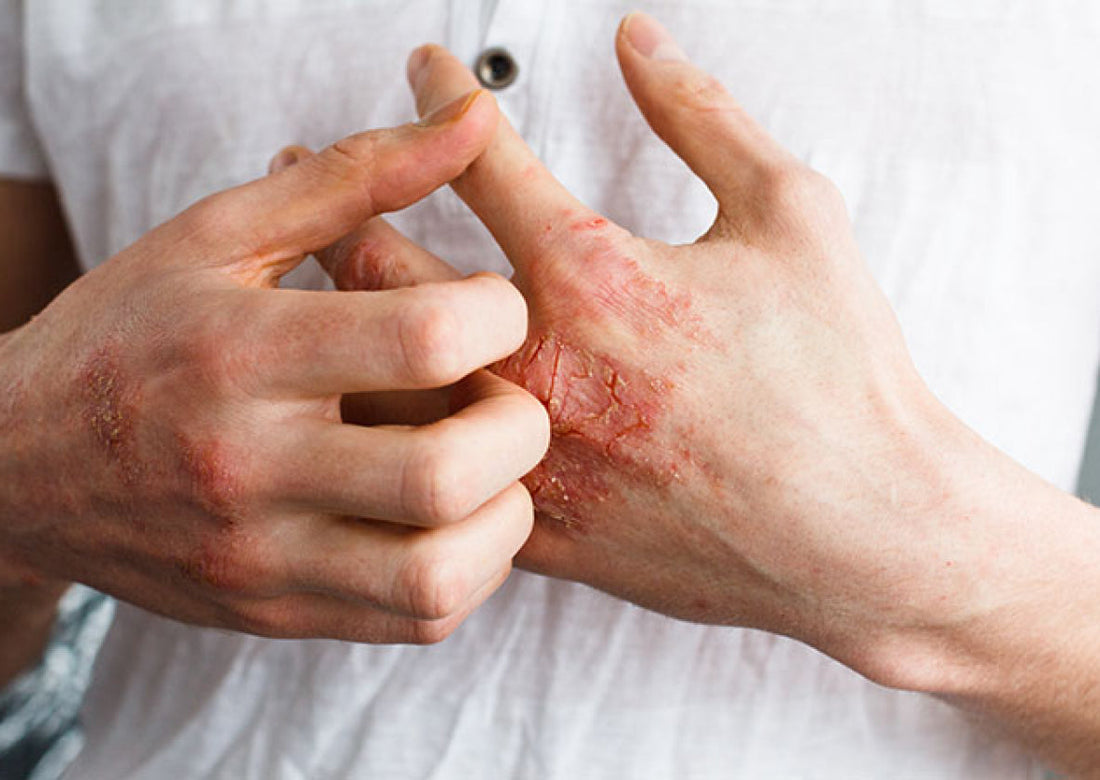 The Complete Guide to Eczema Relief: Managing Skin Rashes and Irritation Naturally