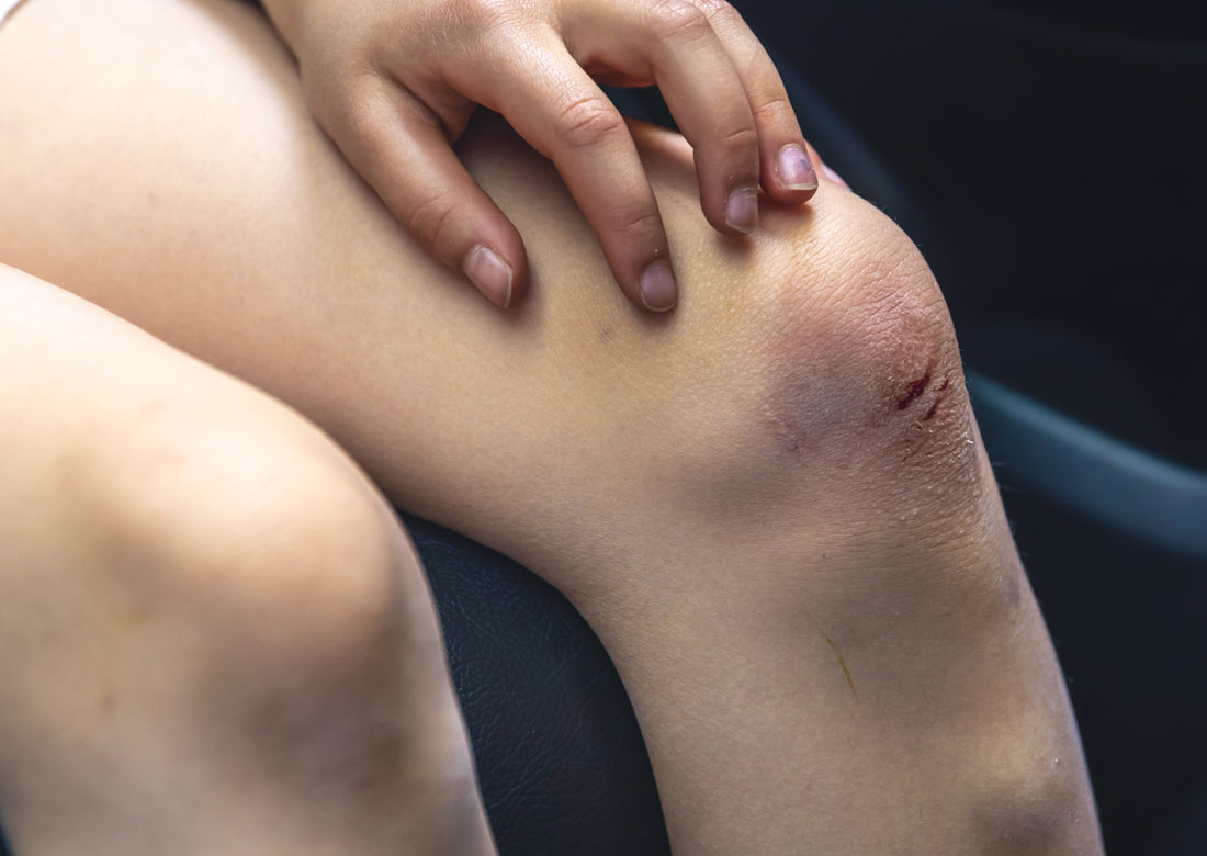 Bruise Easily – Zax's Original