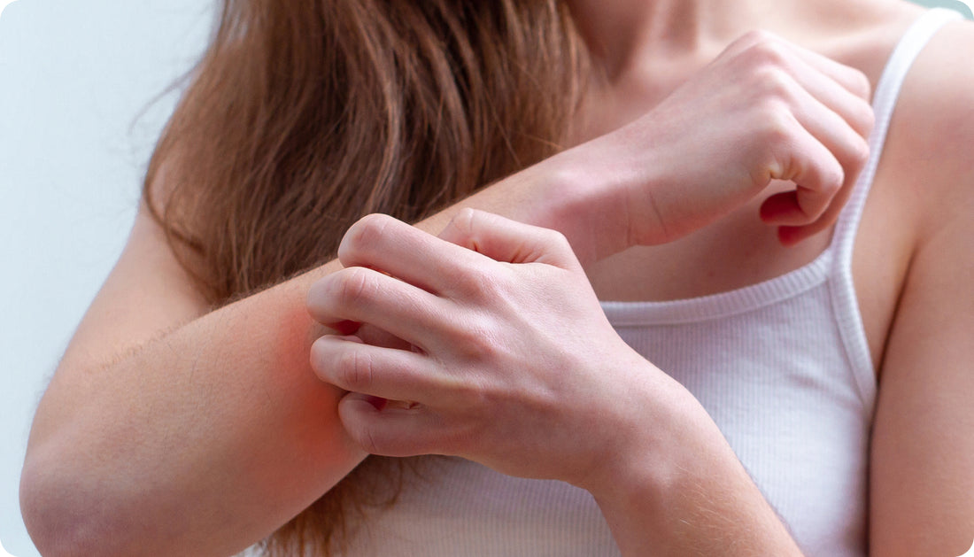 Top 4 Solutions to Itchy Bug Bites